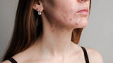 Navigating Hormonal Acne & Unveiling Radiant Skin | Mastering Hormonal Changes